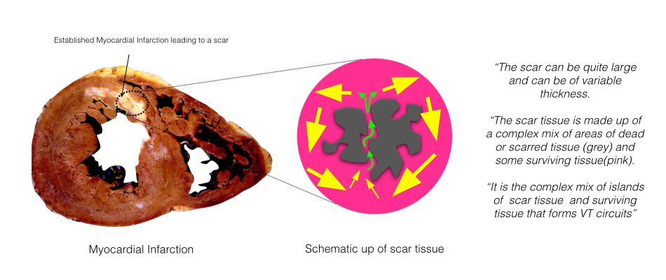 Ventricular Tachycardia Ablation in Structural Heart Disease